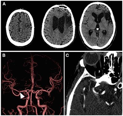 Mechanical Thrombectomy for M1 Subocclusive Thrombus With Lateral Lenticulostriate Artery Occlusion: A Case Report and Literature Review